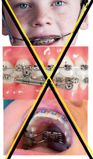 Invid=salign First treatment without regular braces photo